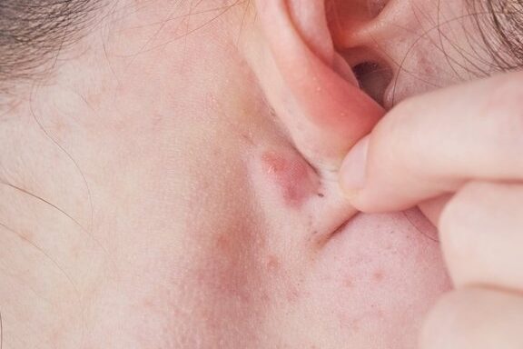 Descubre el misterio detrás del bulto en el lóbulo de la oreja